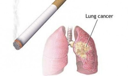 bahaya-kanker-paru-paru