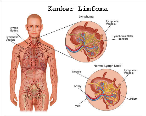 Kanker-Limfoma