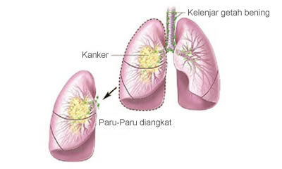 lung2