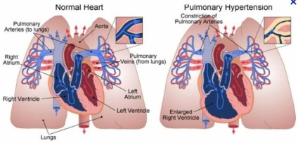ph-hearts