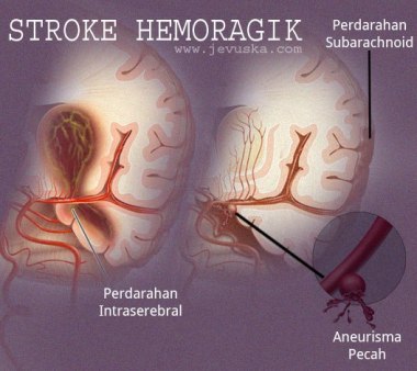 stroke-hemoragik jevuska