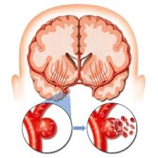 stroke-hemoragik subarachnoid
