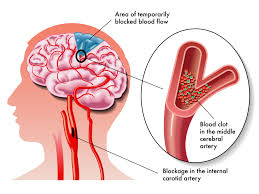 stroke hemoragik